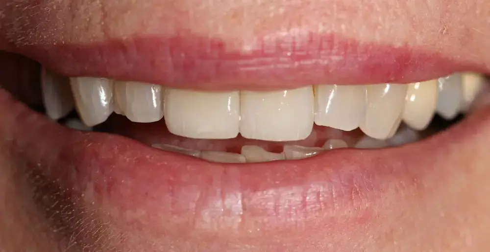 Summit_Dr_Erickson_Dr_Keck_Dr_Kaiser_1420 E. McAndrews Rd, Medford, OR 97504 Summit_Dr_Erickson_Dr_Keck_Dr_Kaiser_1420 E. McAndrews Rd, Medford, OR 97504 Smile Gallery Medford Before and Afters