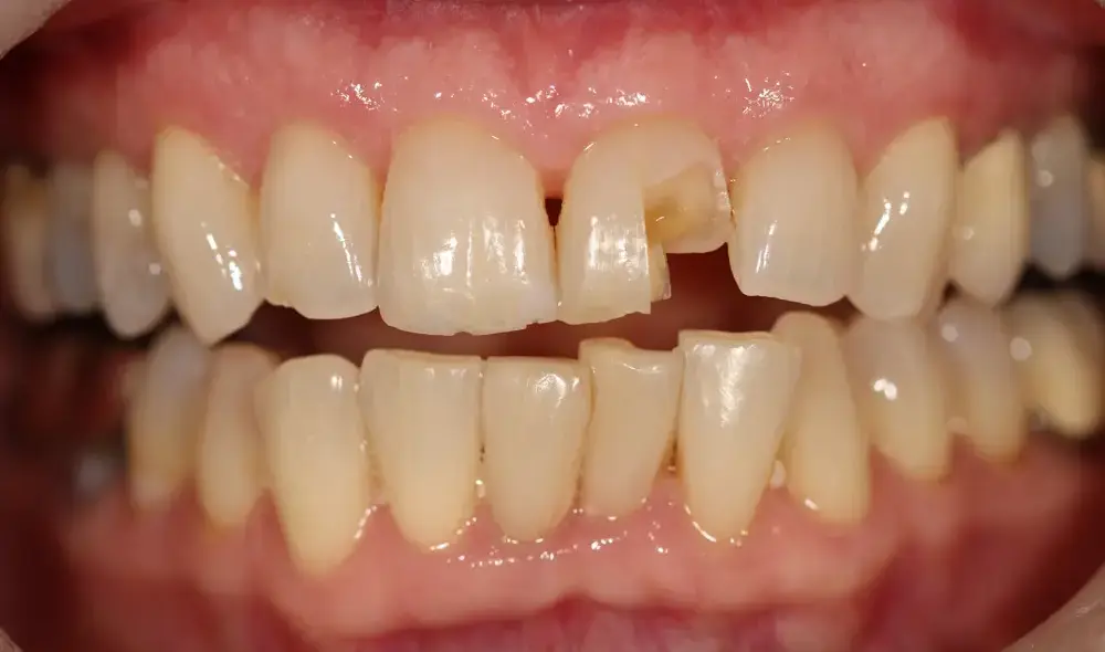 Summit_Dr_Erickson_Dr_Keck_Dr_Kaiser_1420 E. McAndrews Rd, Medford, OR 97504 Summit_Dr_Erickson_Dr_Keck_Dr_Kaiser_1420 E. McAndrews Rd, Medford, OR 97504 Smile Gallery Medford Before and Afters