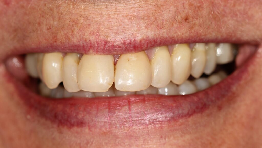 Summit_Dr_Erickson_Dr_Keck_Dr_Kaiser_1420 E. McAndrews Rd, Medford, OR 97504 Summit_Dr_Erickson_Dr_Keck_Dr_Kaiser_1420 E. McAndrews Rd, Medford, OR 97504 Smile Gallery Medford Before and Afters